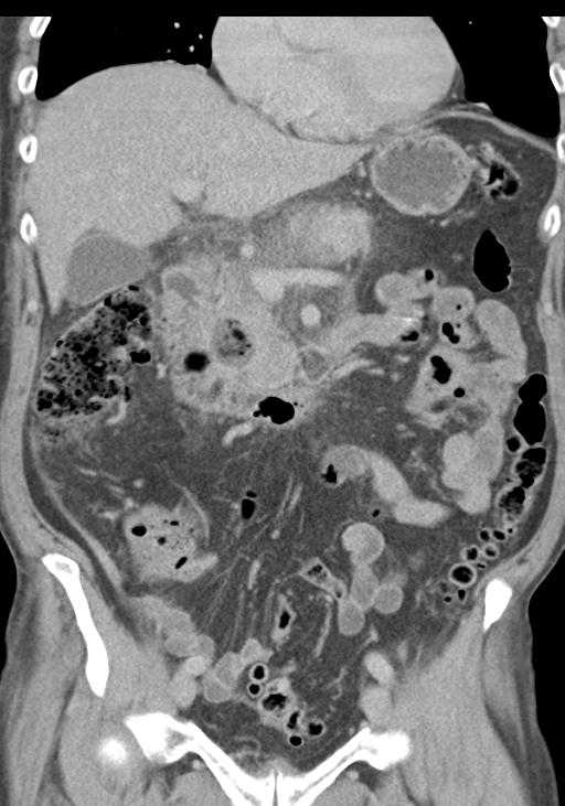 Acute pancreatitis and walled-off necrosis (Radiopaedia 29888-30403 E 25).jpg