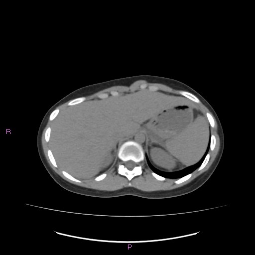 Acute pancreatitis secondary to stone at minor papilla and pancreatic divisum (Radiopaedia 76570-88333 Axial non-contrast 14).jpg