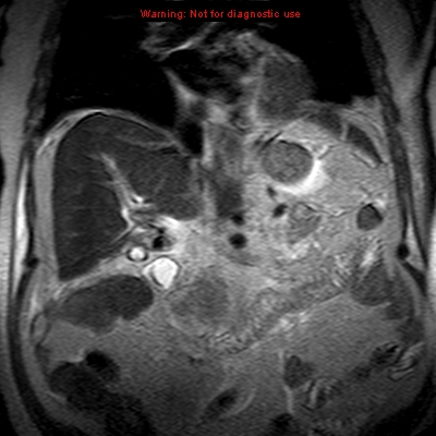 File:Acute pancreatitis with incidental pancreatic lipoma (Radiopaedia 10190-10732 Coronal T2 16).jpg