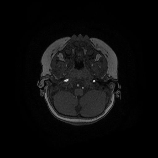 Acute phase of hemiconvulsion-hemiplegia epilepsy syndrome (Radiopaedia 29309-29745 Axial TOF angiography 135).jpg