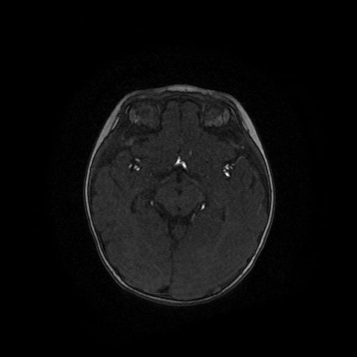 Acute phase of hemiconvulsion-hemiplegia epilepsy syndrome (Radiopaedia 29309-29745 Axial TOF angiography 71).jpg