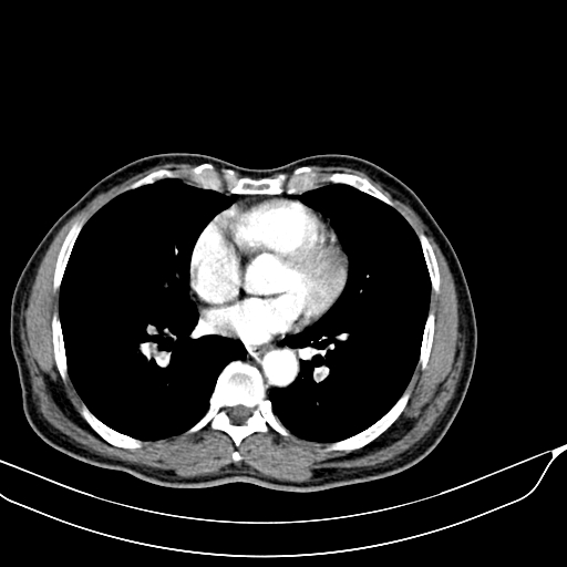 Acute pulmonary embolism (Radiopaedia 69510-79390 D 40).jpg