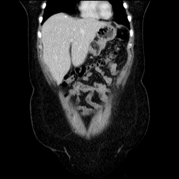 Acute pyelonephritis (Radiopaedia 33397-34434 Coronal renal parenchymal phase 24).jpg