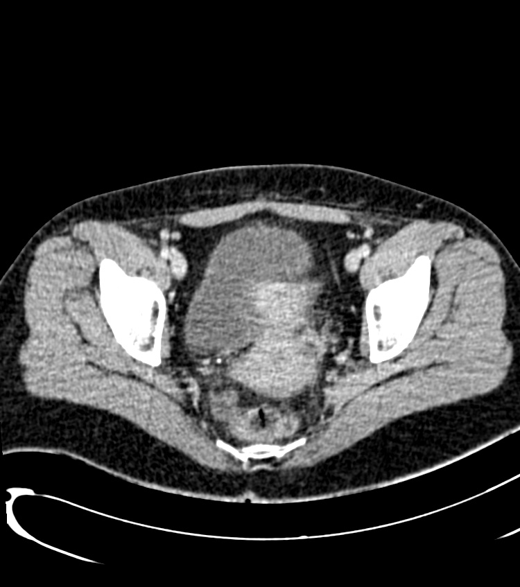 Acute pyelonephritis (Radiopaedia 40264-42816 Axial C+ portal venous phase 57).jpg
