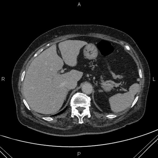 Acute renal artery occlusion (Radiopaedia 86586-102682 Axial C+ delayed 14).jpg