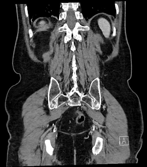 Acute renal infarction (Radiopaedia 59375-66736 Coronal C+ portal venous phase 52).jpg