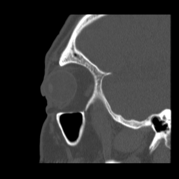 Acute sinusitis (Radiopaedia 23161-23215 Sagittal bone window 14).jpg