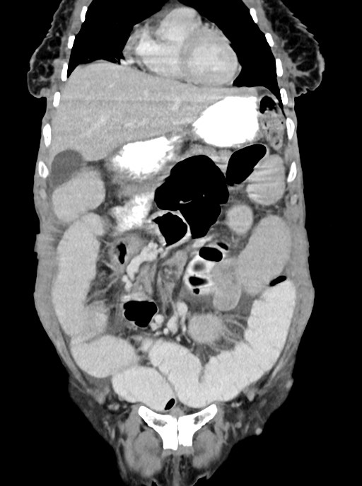 Acute small bowel (ileal) volvulus (Radiopaedia 71740-82139 Coronal C+ portal venous phase 36).jpg