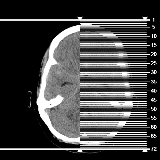 Acute subarachnoid hemorrhage and accessory anterior cerebral artery (Radiopaedia 69231-79008 Coronal non-contrast 1).jpg