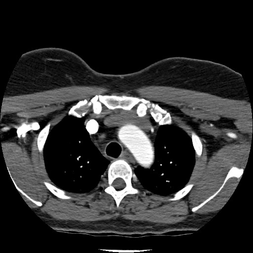 Acute subarachnoid hemorrhage and accessory anterior cerebral artery (Radiopaedia 69231-79009 Axial C+ arterial phase 16).jpg
