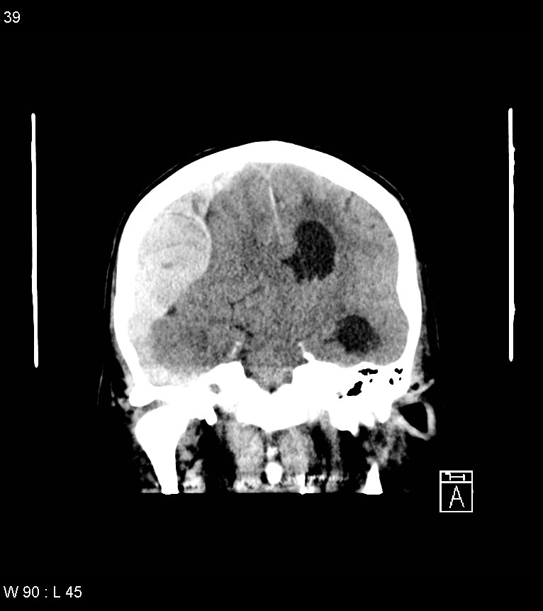 Acute subdural hematoma with myelofibrosis (Radiopaedia 52582-58494 Coronal non-contrast 30).jpg