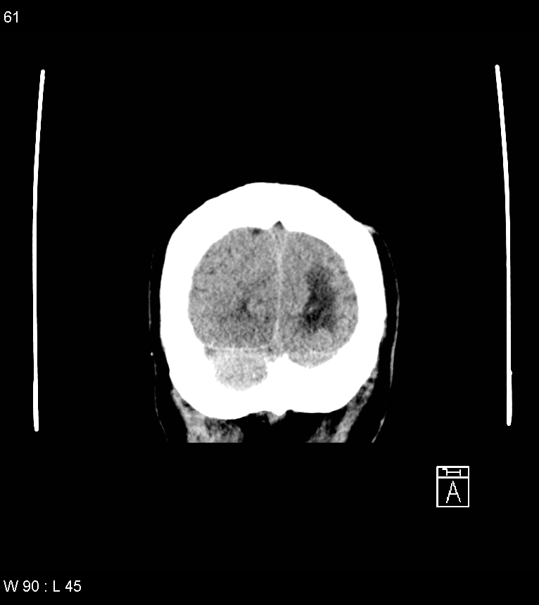 Acute subdural hematoma with myelofibrosis (Radiopaedia 52582-58494 Coronal non-contrast 52).jpg