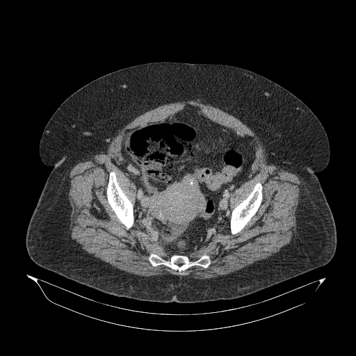 Acute superior mesenteric artery occlusion (Radiopaedia 51288-56960 Axial C+ portal venous phase 85).jpg