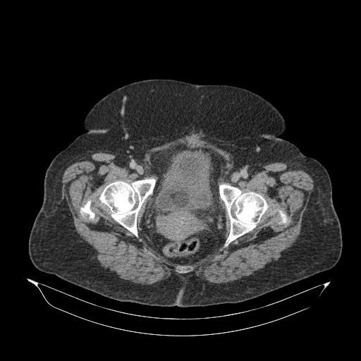 Acute superior mesenteric artery occlusion (Radiopaedia 51288-56960 Axial C+ portal venous phase 96).jpg