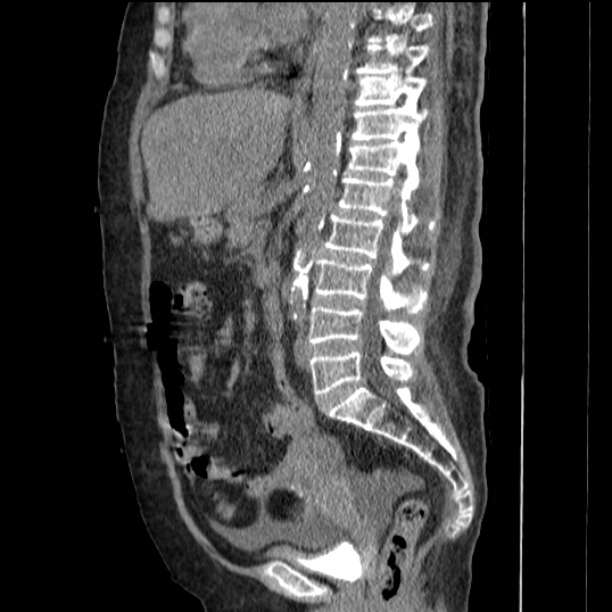 Acute tubular necrosis (Radiopaedia 28077-28334 Sagittal non-contrast 48).jpg