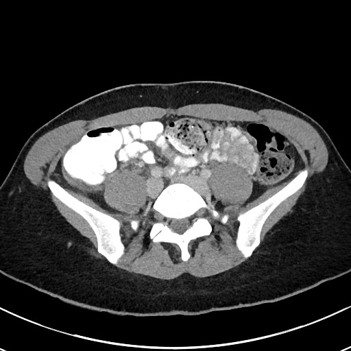 Acute uncomplicated appendicitis (Radiopaedia 61374-69304 Axial C+ portal venous phase 79).jpg