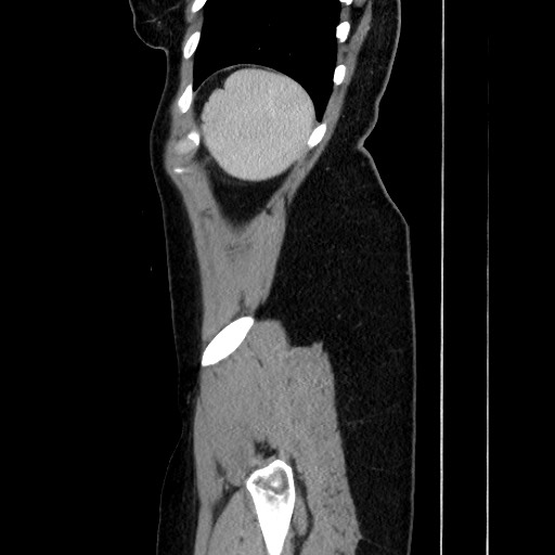 Acute uncomplicated appendicitis (Radiopaedia 73704-84499 Sagittal C+ portal venous phase 171).jpg