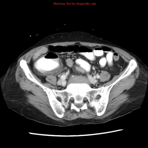 Adenocarcinoma of the colon (Radiopaedia 8191-9039 Axial liver window 54).jpg
