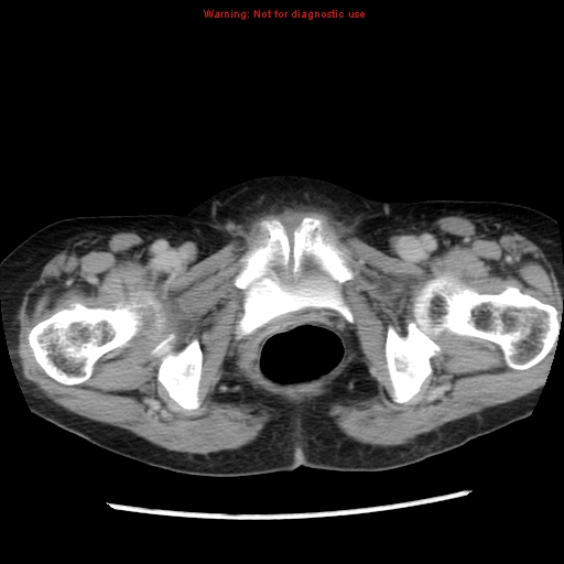 Adenocarcinoma of the colon (Radiopaedia 8191-9039 Axial renal excretory phase 61).jpg