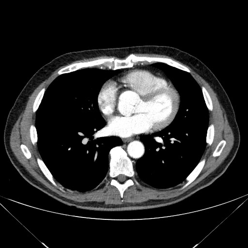 File:Adenocarcinoma of the lung (Radiopaedia 59871-67325 Axial C+ arterial phase 56).jpg