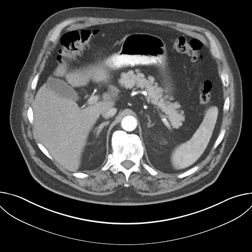 File:Adenocarcioma of rectum- T1 lesion (Radiopaedia 36921-38547 Axial C+ arterial phase 56).png
