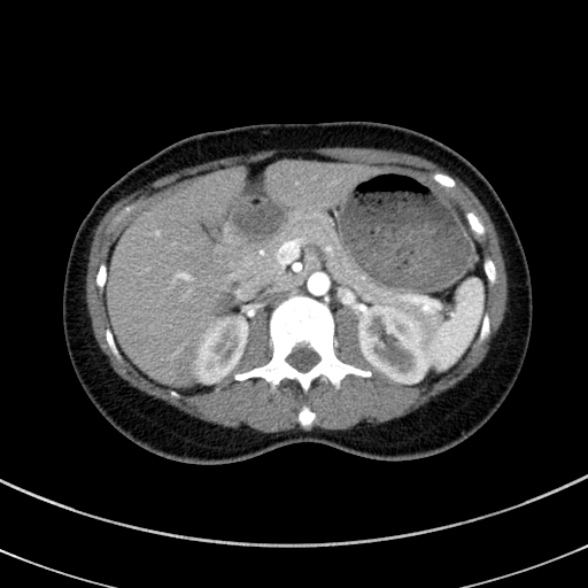 Adenocystic carcinoma of the trachea (Radiopaedia 47677-52525 Axial C+ arterial phase 84).jpg