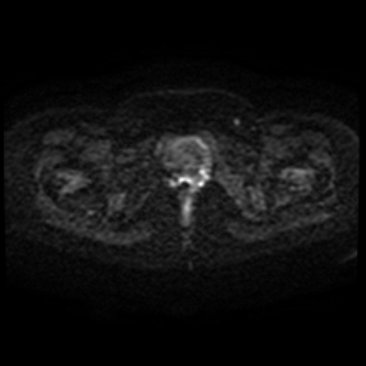 Adenoma malignum of cervix (Radiopaedia 66441-75705 Axial DWI 71).jpg