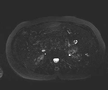 File:Adenomyomatosis of the gallbladder (Radiopaedia 50246-55587 Axial 11).png
