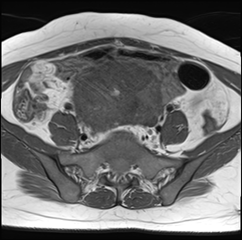 File:Adenomyosis - ovarian endometriomas (Radiopaedia 67031-76350 Axial T1 7).jpg