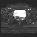 File:Adenomyosis and endometriotic cysts (Radiopaedia 82300-96367 Axial DWI 3).jpg
