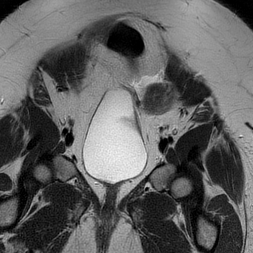 File:Adenomyosis within a didelphys uterus (Radiopaedia 70175-80215 Coronal T2 9).jpg