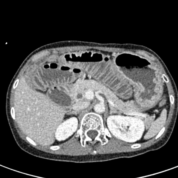 File:Adhesional small bowel obstruction (Radiopaedia 48397-53305 Axial C+ portal venous phase 19).jpg