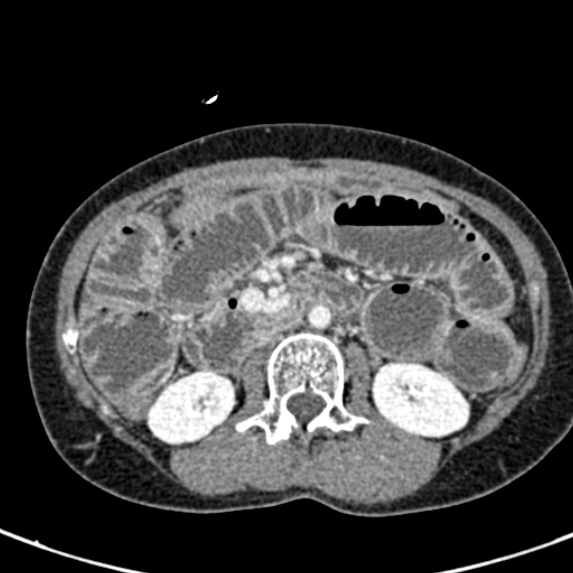 Adhesional small bowel obstruction (Radiopaedia 48397-53305 Axial C+ portal venous phase 34).jpg