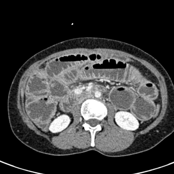 Adhesional small bowel obstruction (Radiopaedia 48397-53305 Axial C+ portal venous phase 36).jpg