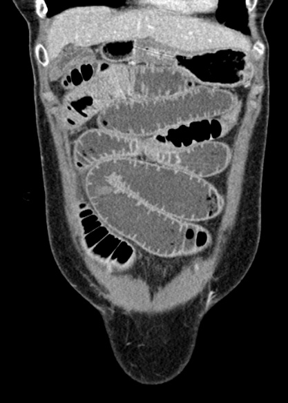Adhesional small bowel obstruction (Radiopaedia 48397-53305 Coronal C+ portal venous phase 75).jpg