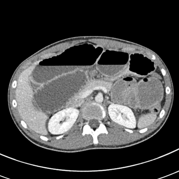 Adhesional small bowel obstruction (Radiopaedia 52107-57980 Axial C+ portal venous phase 35).jpg