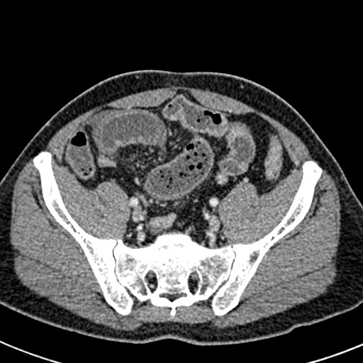 Adhesional small bowel obstruction (Radiopaedia 58900-66131 Axial C+ portal venous phase 41).jpg