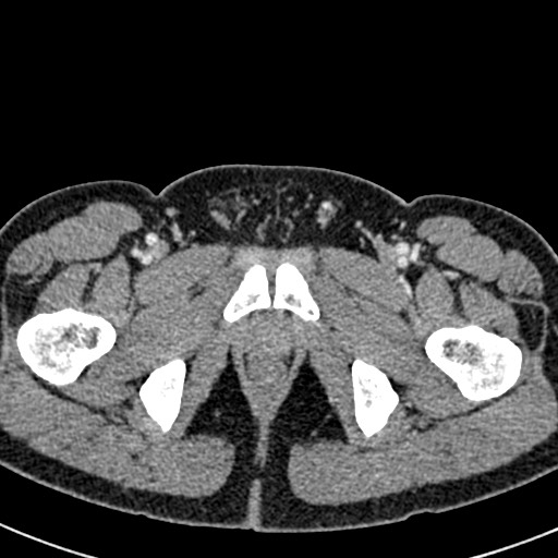 Adhesional small bowel obstruction (Radiopaedia 58900-66131 Axial C+ portal venous phase 55).jpg