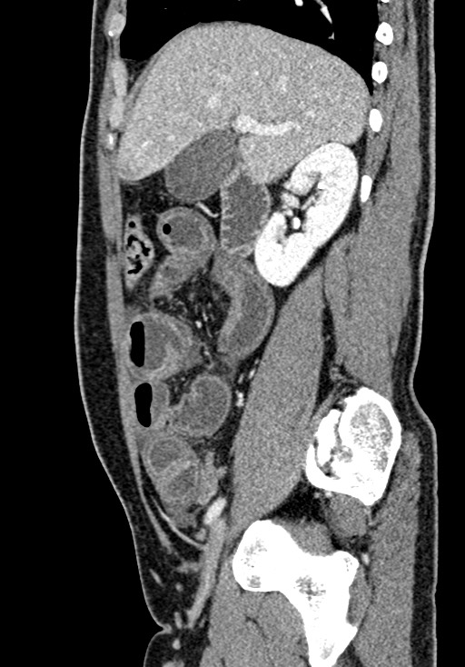 Adhesional small bowel obstruction (Radiopaedia 58900-66131 Sagittal C+ portal venous phase 82).jpg