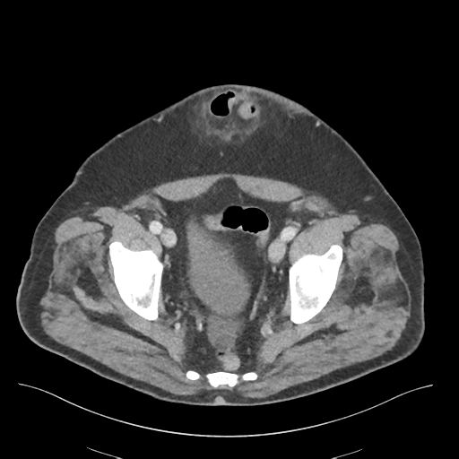 Adhesions within abdominal wall hernia (Radiopaedia 58283-65394 Axial C+ portal venous phase 74).png