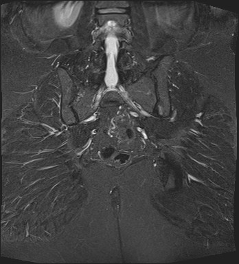 File:Adnexal multilocular cyst (O-RADS US 3- O-RADS MRI 3) (Radiopaedia 87426-103754 Coronal T2 fat sat 26).jpg