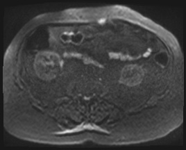 Adrenal cortical carcinoma (Radiopaedia 64017-72770 Axial DWI 119).jpg