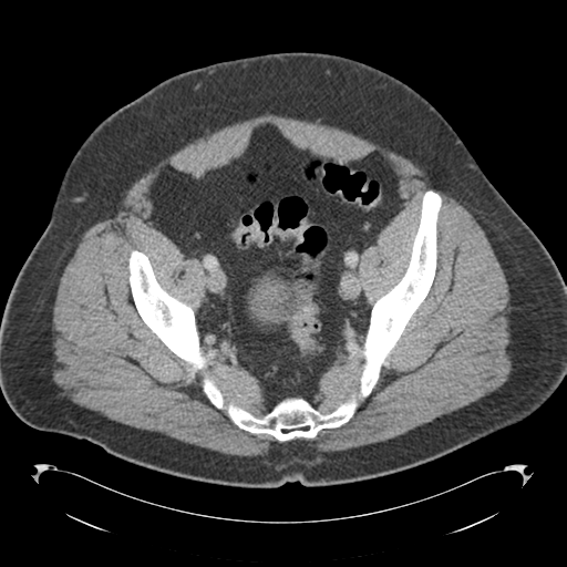 Adrenal cyst (Radiopaedia 45625-49776 Axial C+ portal venous phase 82).png