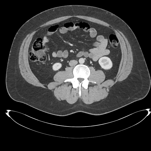 File:Adrenal cyst (Radiopaedia 45625-49778 AXIAL THICK 60 sec 58).png