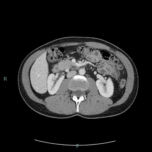 Adrenal cystic lymphangioma (Radiopaedia 83161-97534 Axial C+ portal venous phase 42).jpg