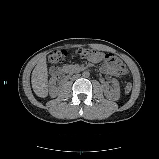 Adrenal cystic lymphangioma (Radiopaedia 83161-97534 Axial non-contrast 44).jpg