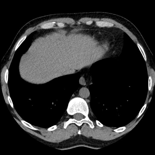 Adrenal gland trauma (Radiopaedia 81351-95079 Axial non-contrast 10).jpg