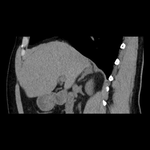 Adrenal gland trauma (Radiopaedia 81351-95079 Sagittal non-contrast 38).jpg