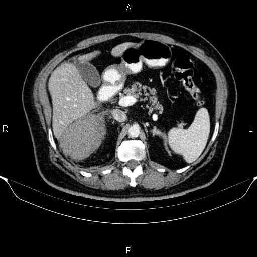 Adrenal hemorrhage (Radiopaedia 62622-70916 Axial C+ portal venous phase 61).jpg