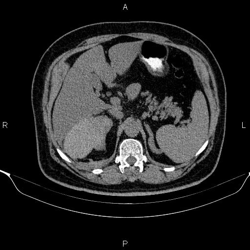 Adrenal hemorrhage (Radiopaedia 62622-70916 Axial non-contrast 52).jpg